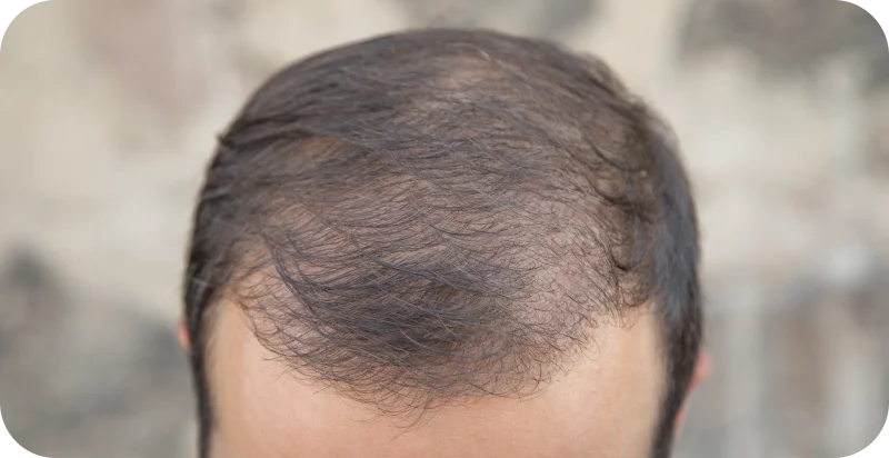 Tratamento Alopecia Androgenética Masculina