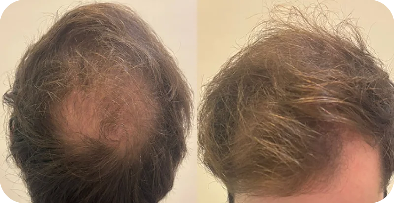 Tratamento Alopecia Androgenética Masculina