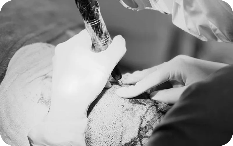 Tratamento Alopecia Androgenética Masculina