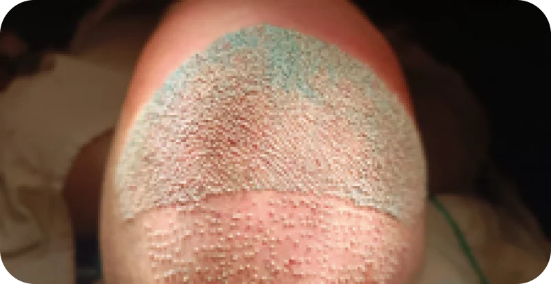 Tratamento Alopecia Androgenética Masculina